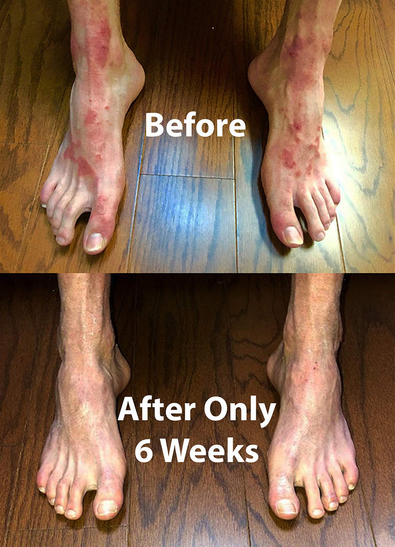 [Australia] - Psorclear-Psoriasis & Eczema Treatment | A Proven Effective and All-Natural Treatment for Psoriasis Eczema & Rosacea Relief That Works (120 Count Bottle) 