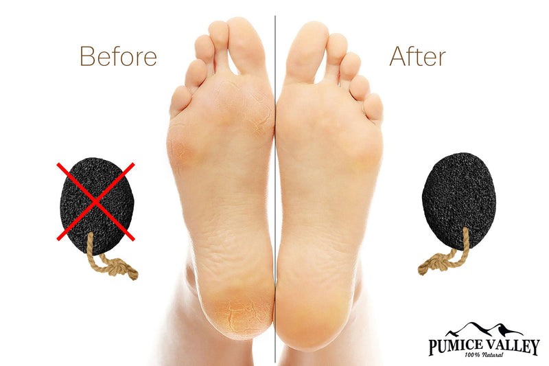 [Australia] - Pumice Stone - Natural Earth Lava Pumice Stone Black - Callus Remover for Feet Heels and Palm - Pedicure Exfoliation Tool - Corn Remover - Dry Dead Skin Scrubber - Health Foot Care 