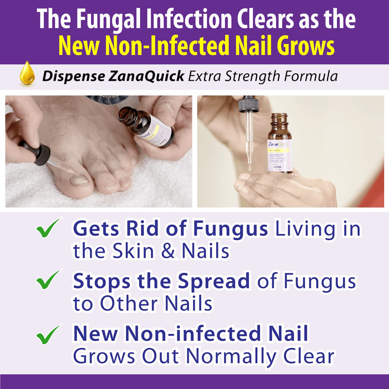 [Australia] - ZanaQuick Toenail Fungus Treatment Drops - 2 Pack - Nail Fungus Treatment For Toenail Remedy, Powerful Nail Fungus Treatment For Fingernail & Toenail 