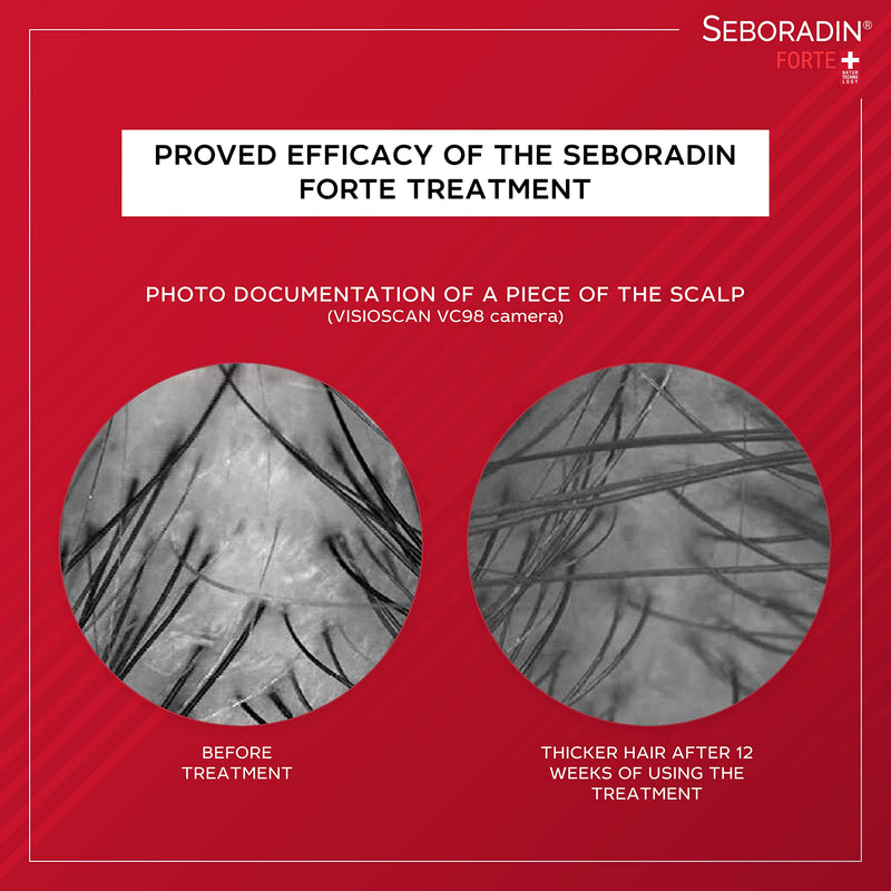 [Australia] - SEBORADIN FORTE Hair Balm for Hair Loss, Hair Thinning Premium Conditioner 200 ml | With Vitamins and Natural Extracts for Thickening and Growth, Natur Technology | Hair & Scalp Treatment | Hair Care 