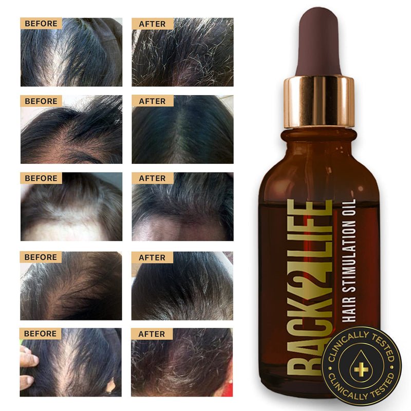 [Australia] - Back2Life 100% Natural Hair Stimulation & Beard Growth Oil-Get Rid of Patchy Beards & Hair-Beard serum to Moisturise, Hydrate & Condition-Repair & Rebalance Your Scalp & Regrow your Head & Beard Hair 