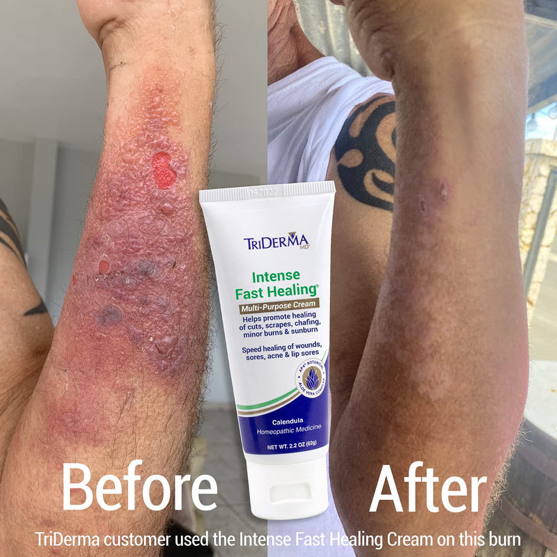 [Australia] - TriDerma Intense Fast Healing Multi-Purpose Cream for Cuts, Scrapes, Sores, Chafing, Minor Burns and Sunburn (2.2 oz Tube) 