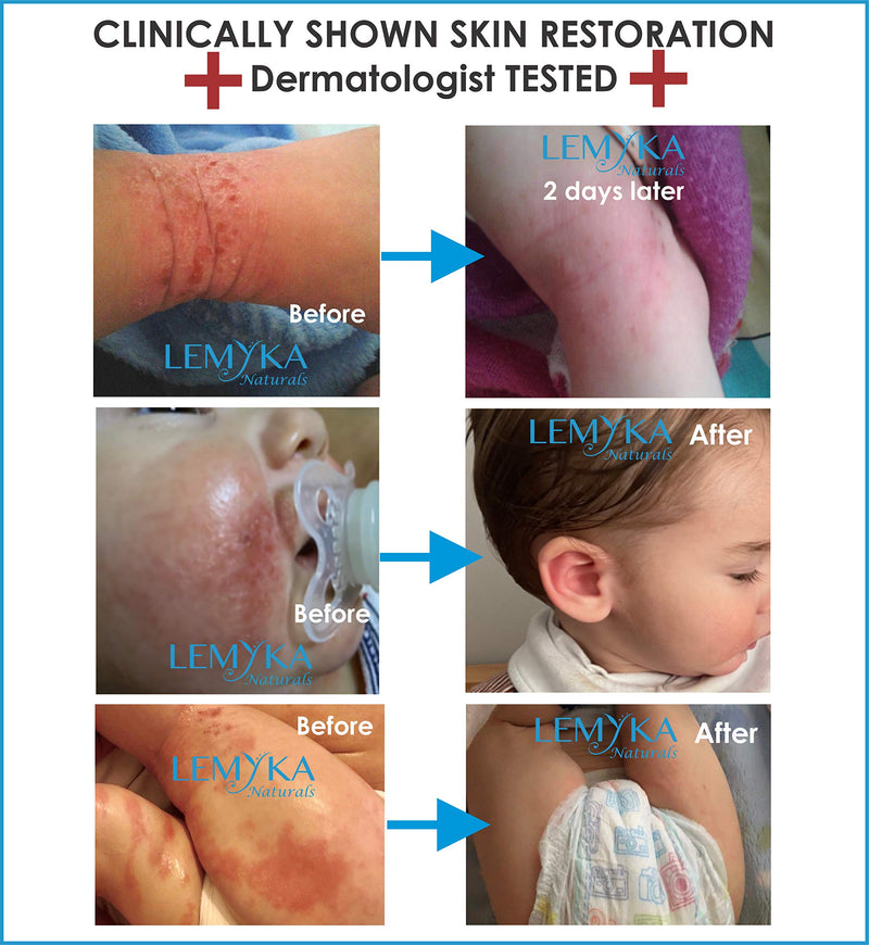 [Australia] - Eczema Cream for Baby, organic Itch relief therapy for dry skin, infant rash, atopic dermatitis, Hives, LEMYKA Soothing balm 