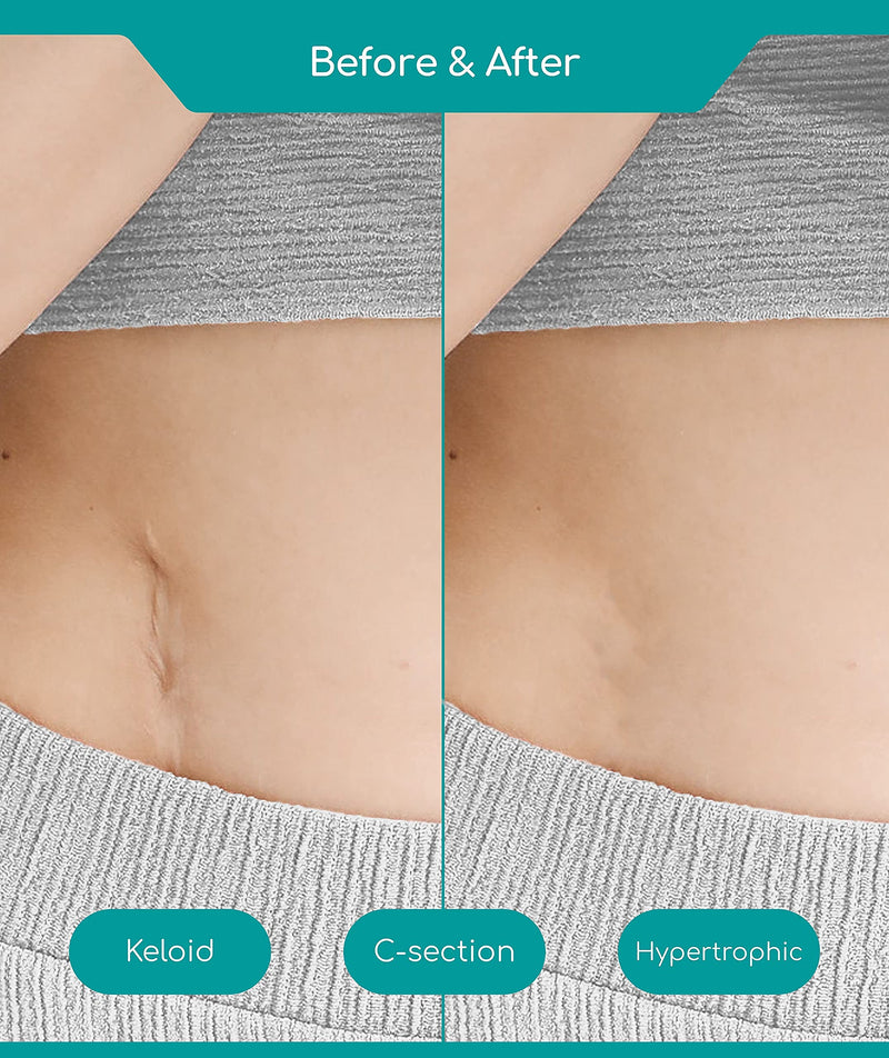 [Australia] - Medi Grade Reusable Silicone Scar Tape for Scars with Storage Sheet 2 Meters, Fast & Effective Scar Removal Tape – Silicone Tape Scars with Perforation for C-Section and Keloid Scar Reduction 