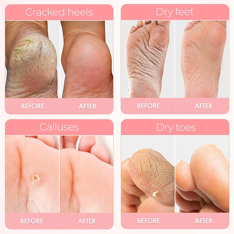 [Australia] - Foot Peel Mask - For Cracked Heels, Dead Skin & Calluses - Makes Your Feet Baby Soft - Removes & Repairs Rough Heels, Dry Toe Skin - Exfoliating Peeling Natural Treatment (3 Pack, Women's 5-11) Women's 5-11 (3 Pack) 