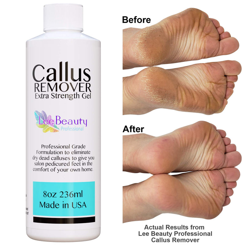 [Australia] - 8oz Callus Remover gel for feet for a professional pedicure. Better results than, foot file, pumice stone, foot scrubber, foot buckets & callus shaver. Rid ugly callouses from feet in minutes 8 Ounce (Pack of 1) 