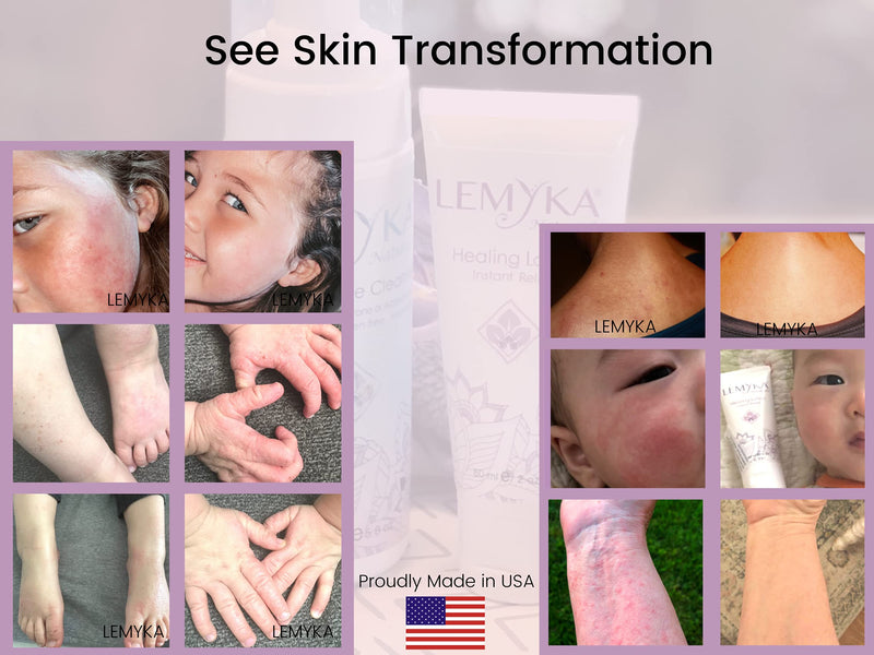 [Australia] - LEMYKA Eczema Lotion for dry itchy skin- Rosacea treatment Face Rash Cream- Itch Redness Relief for Dermatitis, hives, baby acne, Heat Rash- Natural Calendula, Sea buckthorn oil balm for kids & adults 