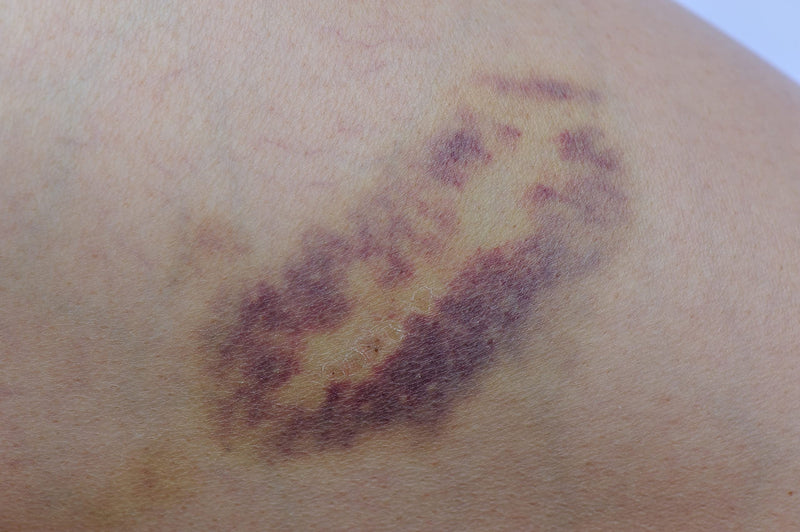 [Australia] - Arnica Bruise Cream Arnica Oil for Bruising Arnica Massage Oil Arnica Massage Balm Made in Yorkshire (250ml Oil) 250ml Oil 
