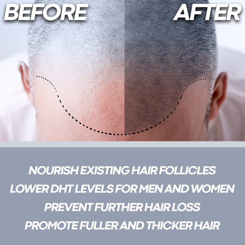 [Australia] - Foli-Tonic Advanced DHT Blocker To Stop Hair Loss, Hair Thinning & Help Thicker Hair Growth - Hair Regrowth Vitamin Supplement for Men and Women, 60 Vegan Capsules 