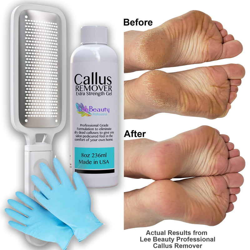 [Australia] - 8oz Callus Remover Gel and Foot File/Foot Rasp Spa Kit. Professional Foot Care for dry, cracked heels. Soak in foot spa then apply callus gel to feet, and use foot scraper to peel off dead skin. 