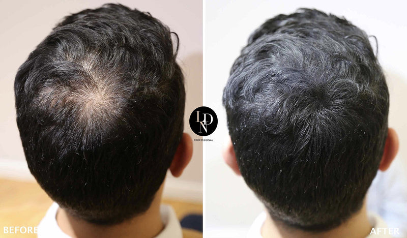 [Australia] - LDN Professional Hair Building Fibres - No1. Hair Fibres for Hair Loss and Thin Hair, Instantly Thicken Hair Naturally, 22g hair fiber bottle (Black) Black 