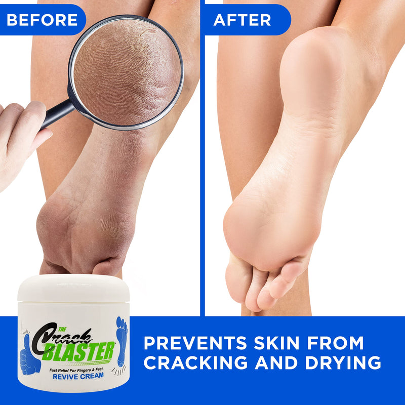 [Australia] - Dry Skin Lanolin Cream for Cracked Heels, Elbows and Soft Hands Crack Blaster Revive 