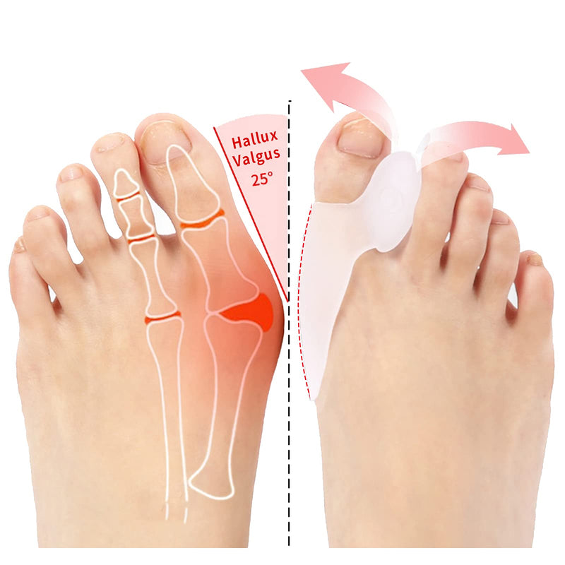 [Australia] - Bunion Guards, Bunion Protector Gel Shield For Pain Relief from Crooked Toes, Relieve Pain from Friction and Pressure Hallux, Bunions, Toe Spreader Cushion Bunion Pads (White) White 